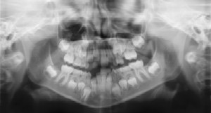 Dental Radiographs (X-Rays) - Pediatric Dentist in Macon, GA