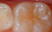 Sealant-Before - Pediatric Dentist in Macon, GA