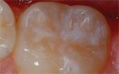 Sealant-After - Pediatric Dentist in Macon, GA